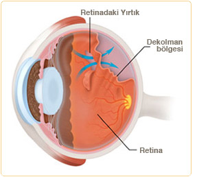 Retinal Yırtık Dekolman hastalık