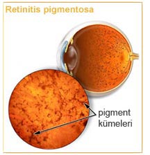 Retinitis Pigmentosa2 hastalık
