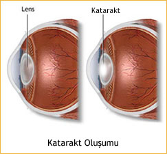 cause of Cataract