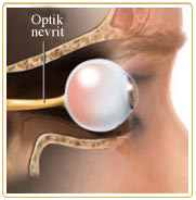 Optik Nevrit1 hastalık